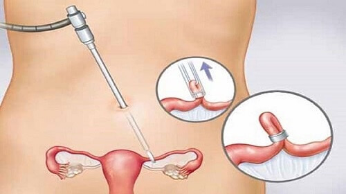 Thông tắc vòi trứng nội soi